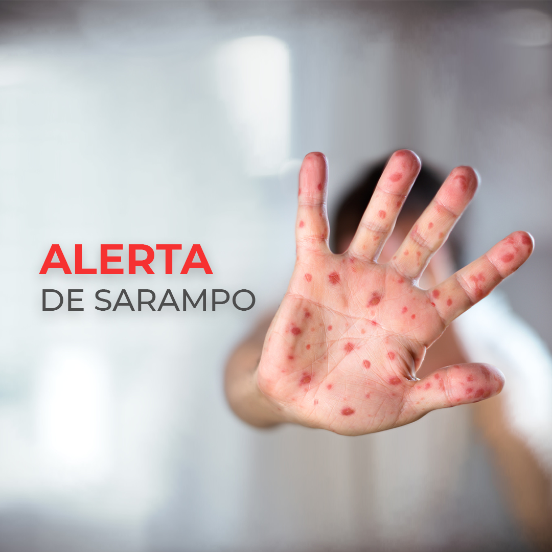 ALERTA DE SARAMPO – Risco de reintrodução do vírus no Paraná